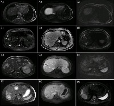 Novel and Specific MRI Features Indicate the Clinical Features of Patients With Rare Hepatic Tumor Epithelioid Hemangioendothelioma